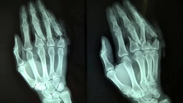 Gãy xương ngón tay - Hình ảnh minh họa